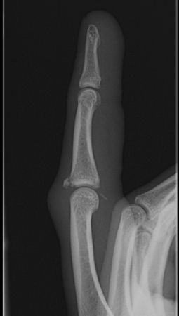 Finger Post Volar Dislocation